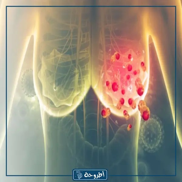 مقدمة إذاعية لموضوع سرطان الثدي
