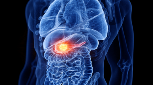الكشف عن الأعراض الأولية لسرطان البنكرياس