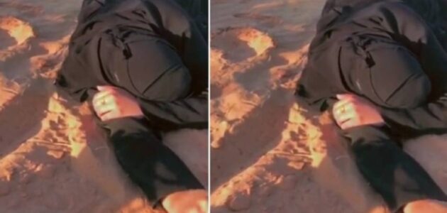 فتاة تصاب بمرض مناعي اسمه الذئب الاحمر فيديو