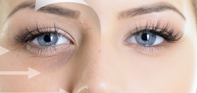 علاج الكدمات السوداء حول العين والأعراض المصاحبة لها