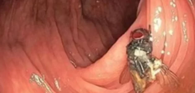 منظار للقولون ينتهي بمفاجأة في أمعاء رجل أمريكي