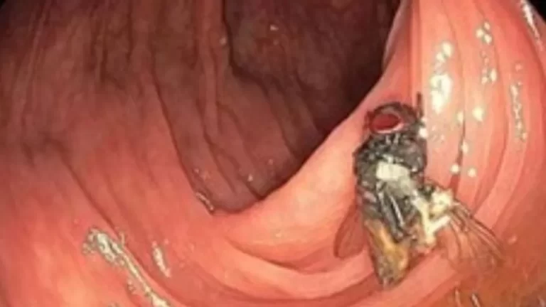 منظار للقولون ينتهي بمفاجأة في أمعاء رجل أمريكي