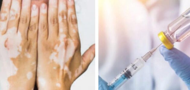 استشاري جلدية يكشف حقيقة فعالية إبر التبييض في علاج البهاق