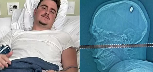 حادثة أغرب من الخيال.. شاب عاش 4 أيام برصاصة في رأسه من دون علمه