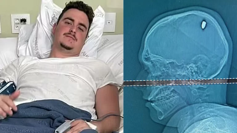 حادثة أغرب من الخيال.. شاب عاش 4 أيام برصاصة في رأسه من دون علمه