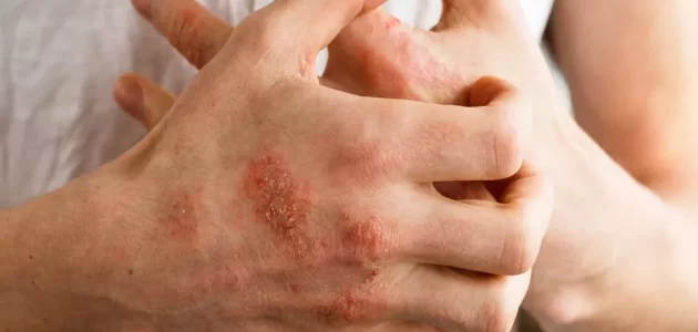 فيديو.. الدكتور موفق طيب يكشف عن كريم فعال لعلاج الإكزيما والصدفية