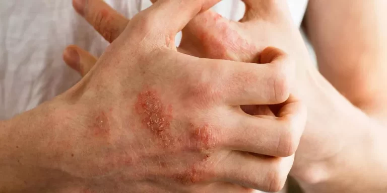 فيديو.. الدكتور موفق طيب يكشف عن كريم فعال لعلاج الإكزيما والصدفية